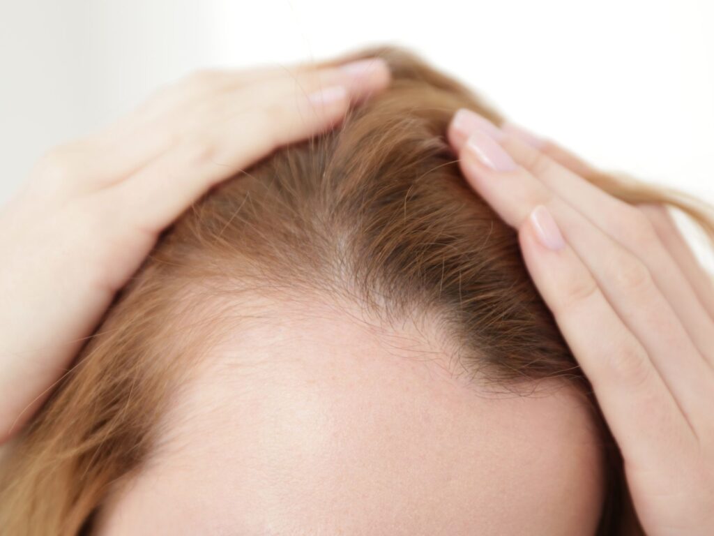 Alopecia Androgenética